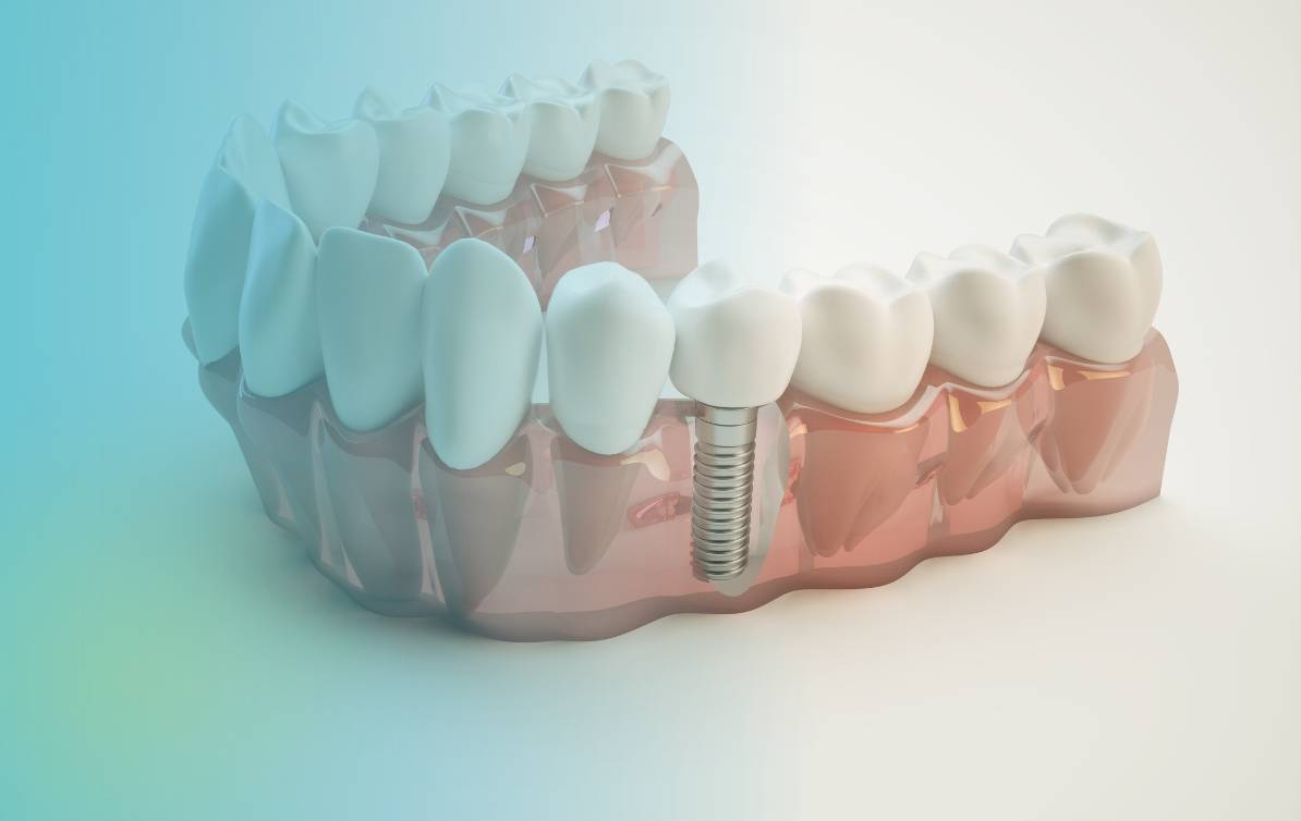 ¿qué Son Los Implantes Dentales Dental Life Especialistas En Servicios Dentales