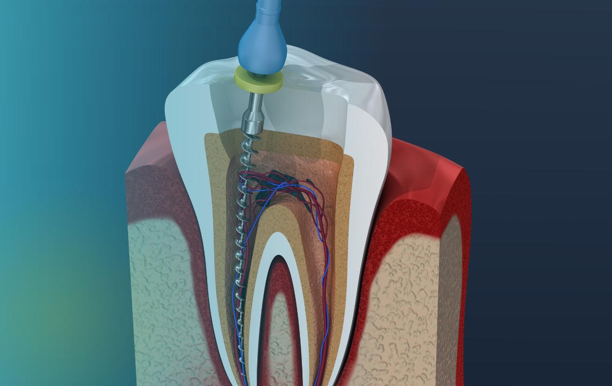 Endodoncia Dental Life Especialistas En Servicios Dentales